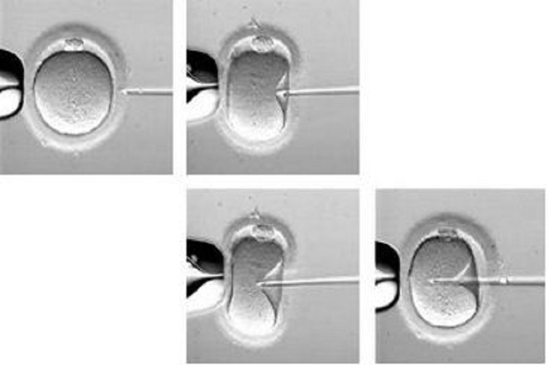 Những nhân tố ảnh hưởng đến kết quả ICSI