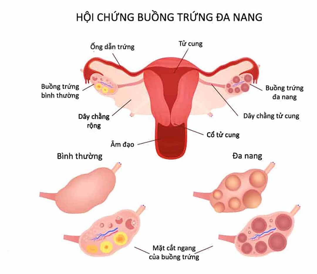 Hội chứng buồng trứng đa nang là gì? Làm gì để cải thiện?