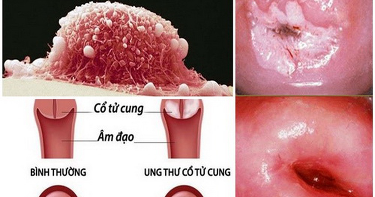 Ung thư cổ tử cung và nhiễm Human Papillomavirus