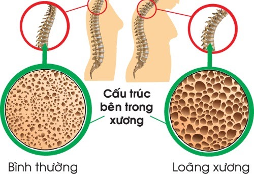 Phòng ngừa loãng xương sau mãn kinh