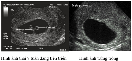 Thai nghén thất bại sớm: dấu hiệu lâm sàng và siêu âm mà bệnh nhân hiếm muộn cần biết